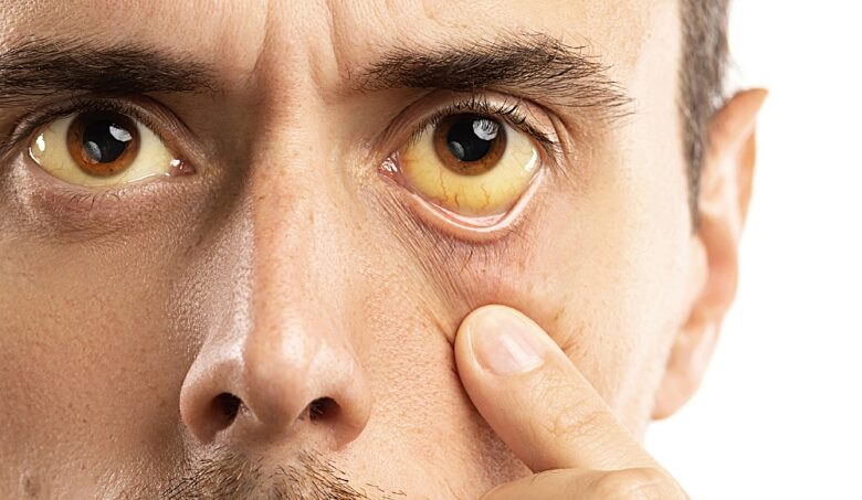 Žloutenka: příznaky, inkubační doba, očkování a prevence