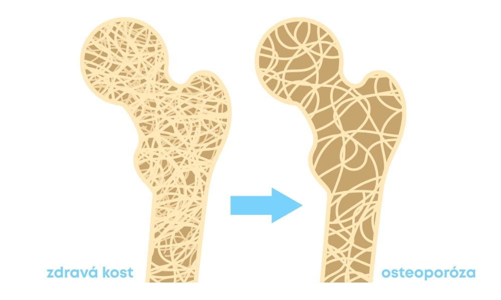 kost postižená osteoporózou